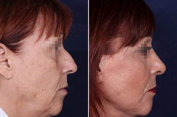 Rhinoplasty Before and After Photos in Philadelphia, PA, Patient 12354