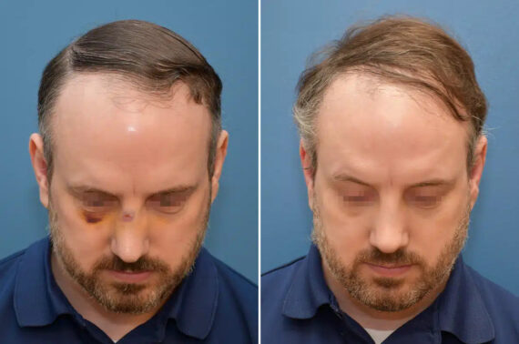 Rhinoplasty Before and After Photos in Philadelphia, PA, Patient 12367