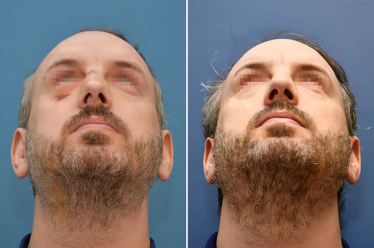 Rhinoplasty Before and After Photos in Philadelphia, PA, Patient 12367