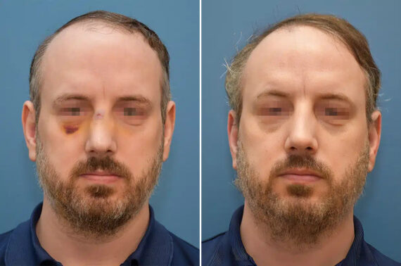 Rhinoplasty Before and After Photos in Philadelphia, PA, Patient 12367