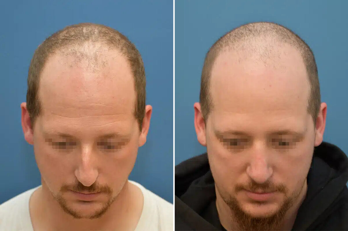 Rhinoplasty Before and After Photos in Philadelphia, PA, Patient 12377