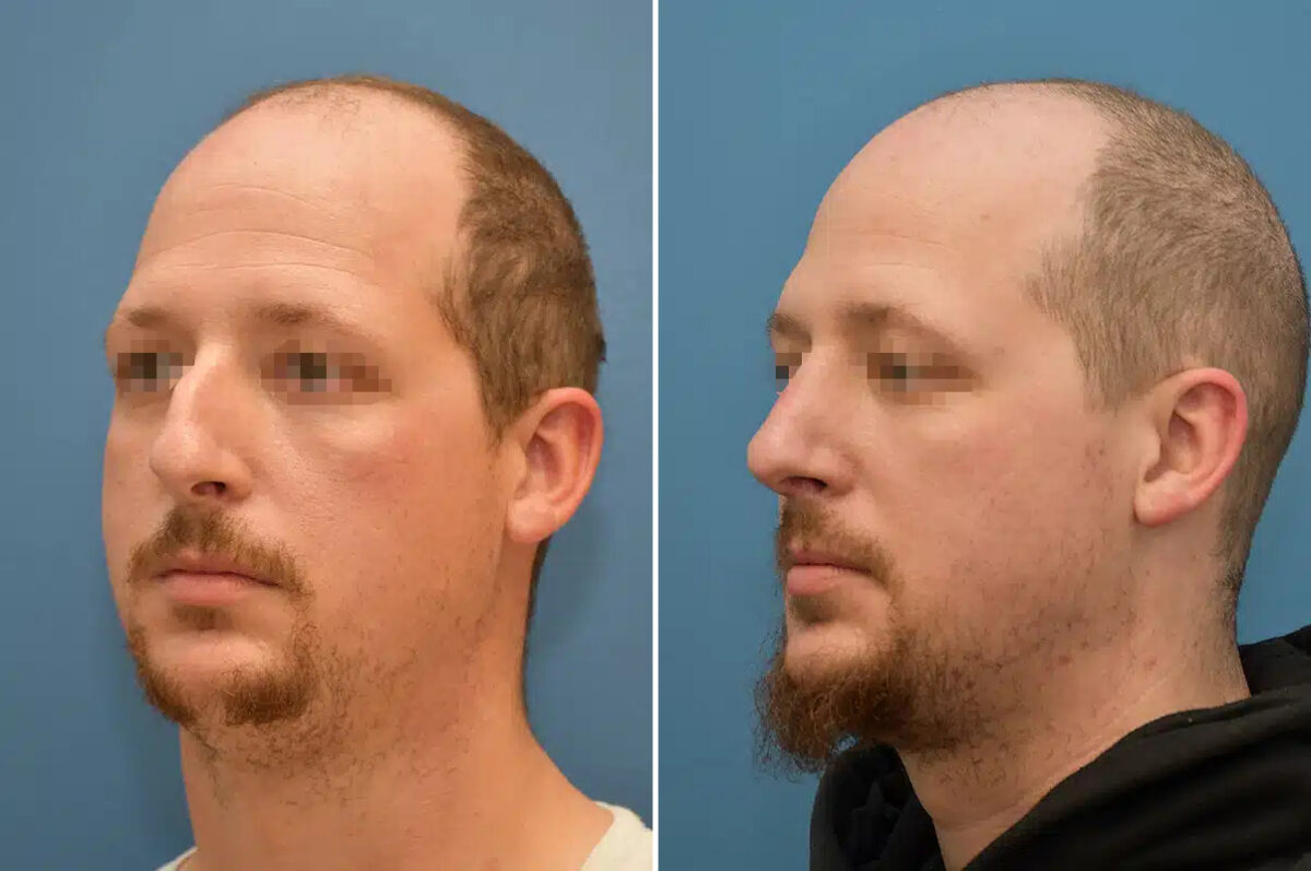 Rhinoplasty Before and After Photos in Philadelphia, PA, Patient 12377