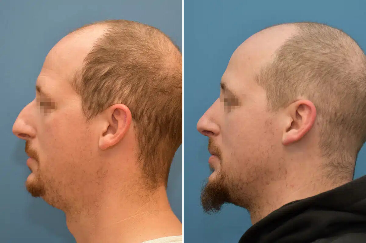 Rhinoplasty Before and After Photos in Philadelphia, PA, Patient 12377