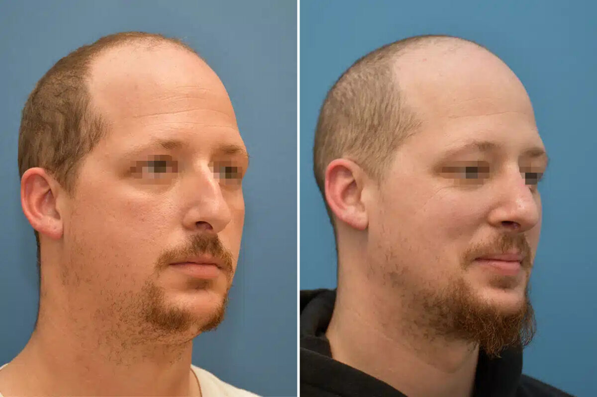 Rhinoplasty Before and After Photos in Philadelphia, PA, Patient 12377