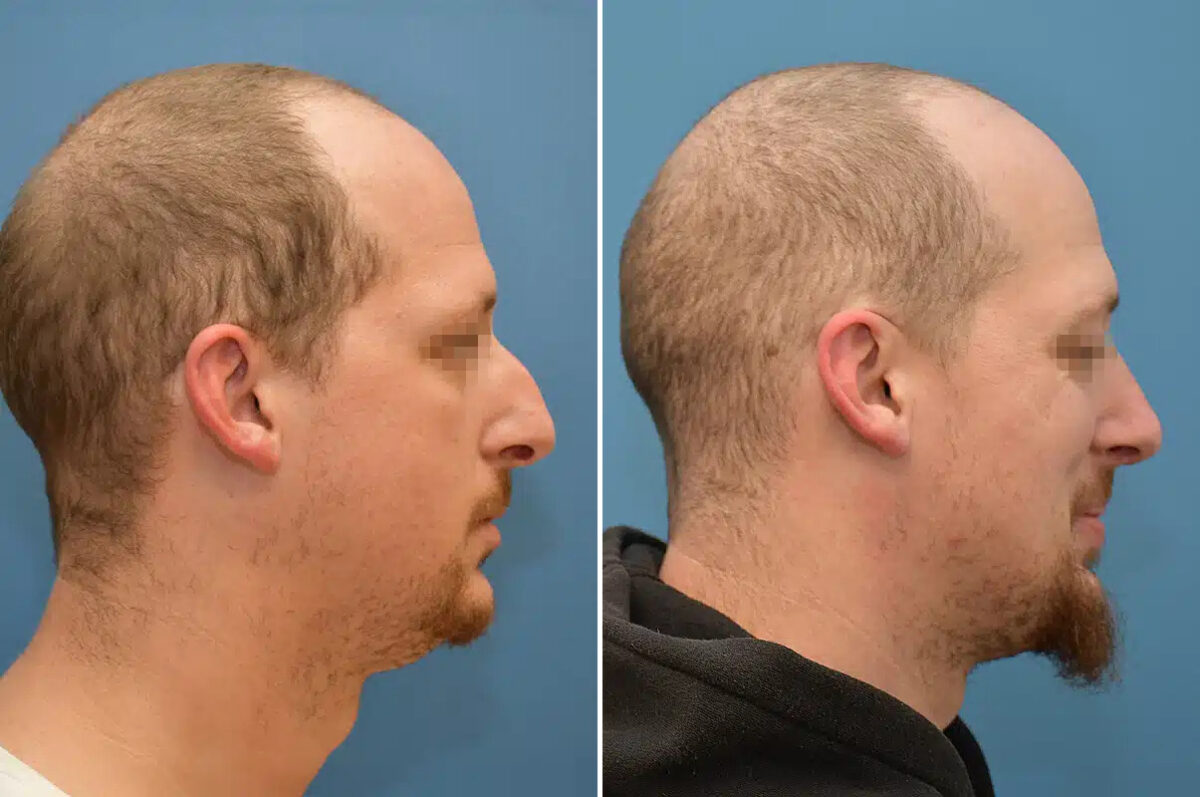 Rhinoplasty Before and After Photos in Philadelphia, PA, Patient 12377
