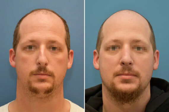 Rhinoplasty Before and After Photos in Philadelphia, PA, Patient 12377