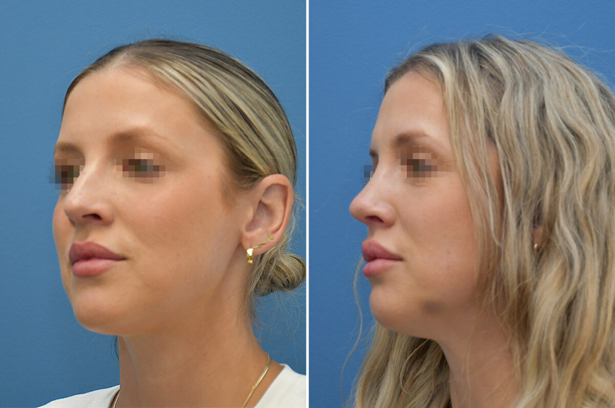 Rhinoplasty Before and After Photos in Philadelphia, PA, Patient 12396