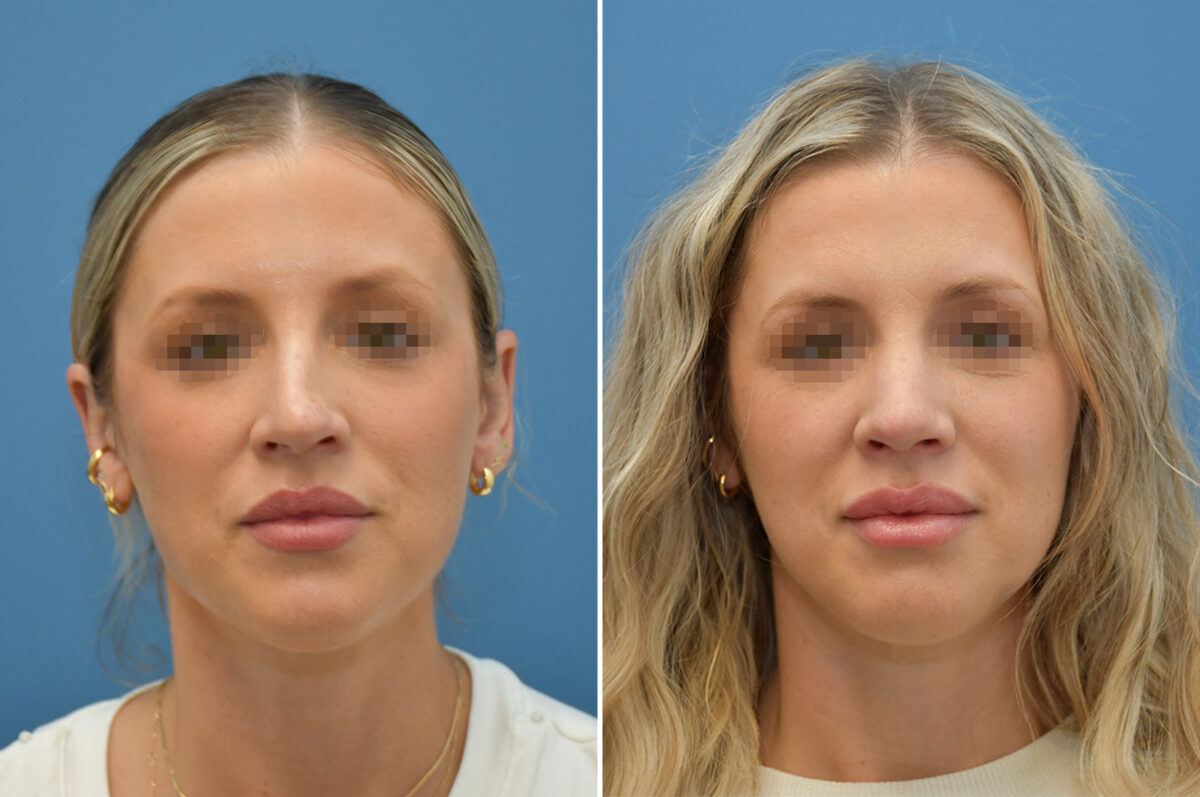Rhinoplasty Before and After Photos in Philadelphia, PA, Patient 12396