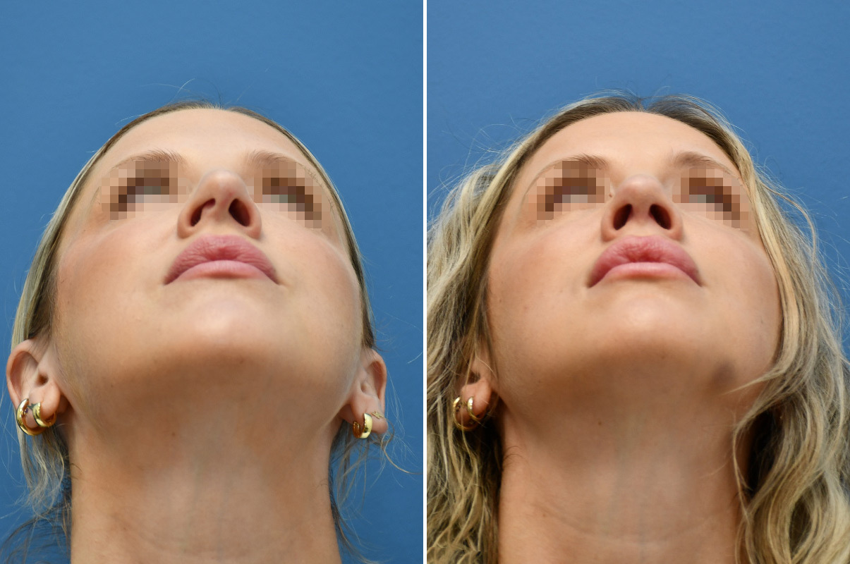 patient-12396-rhinoplasty-before-after