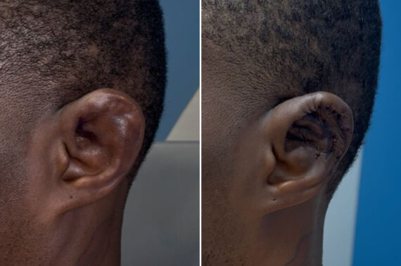 Otoplasty Before and After Photos in Philadelphia, PA, Patient 12415