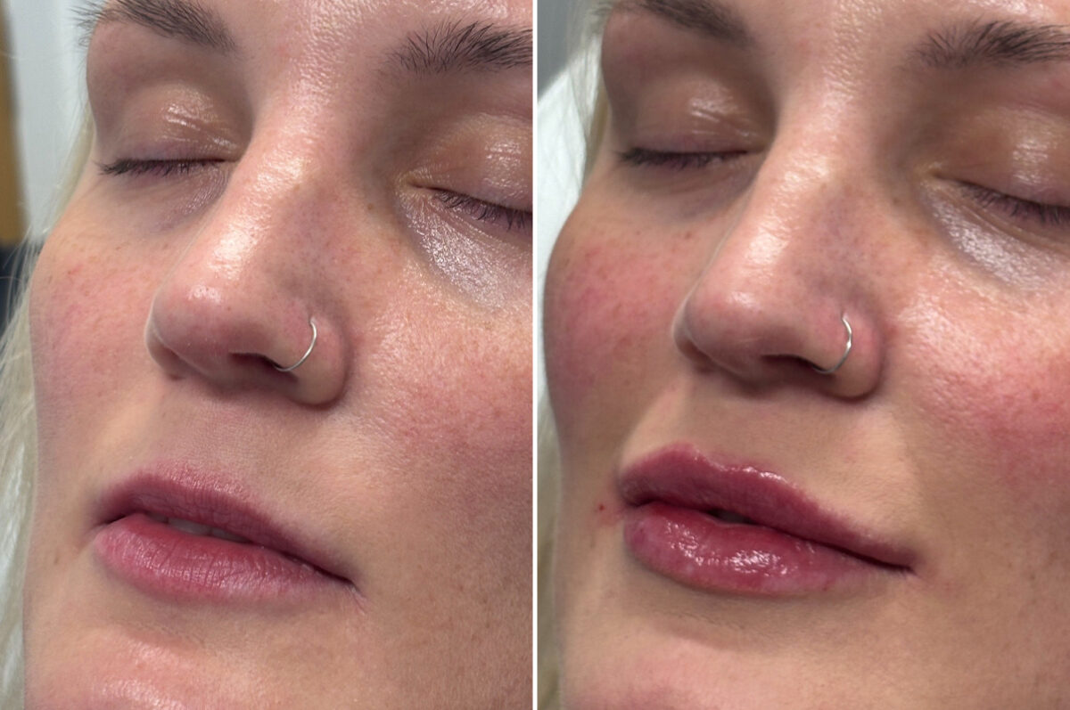 Injectable Fillers Before and After Photos in Philadelphia, PA, Patient 12668
