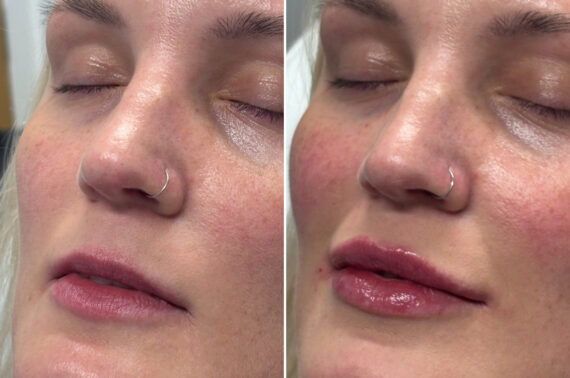 Injectable Fillers Before and After Photos in Philadelphia, PA, Patient 12668