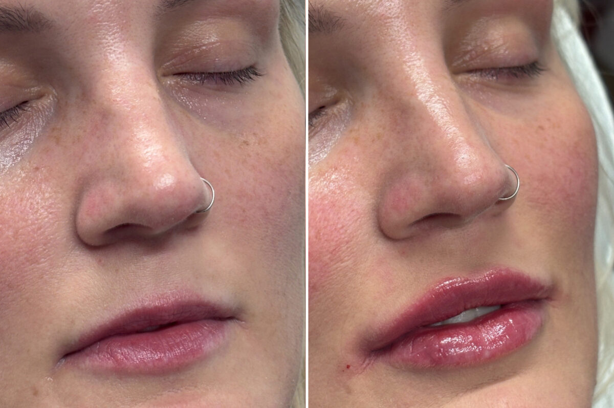 Injectable Fillers Before and After Photos in Philadelphia, PA, Patient 12668