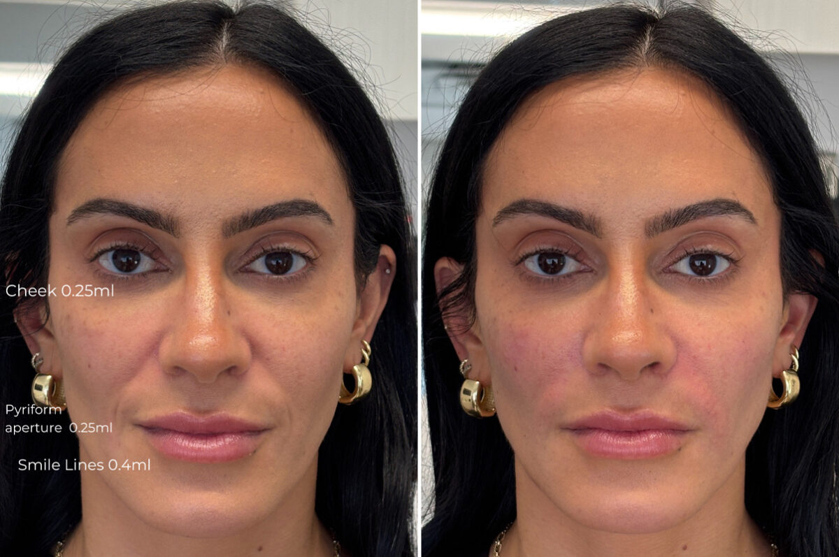 Injectable Fillers Before and After Photos in Philadelphia, PA, Patient 12675