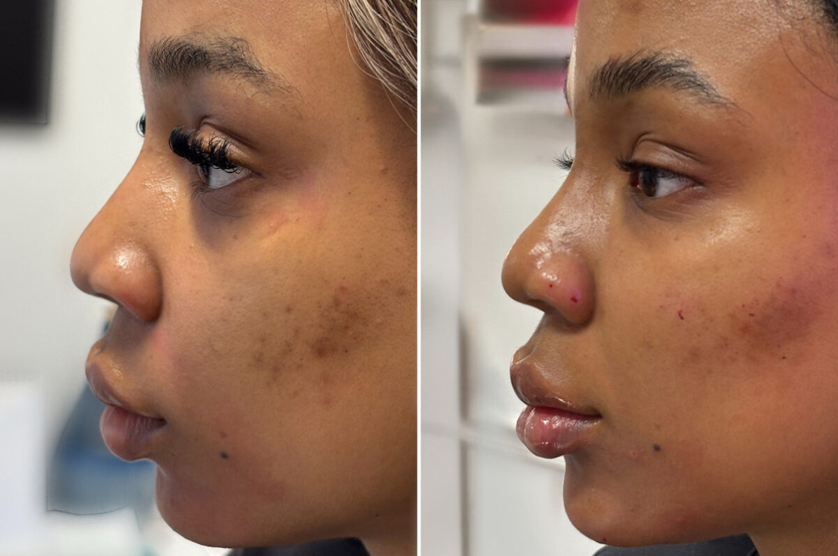 Injectable Fillers Before and After Photos in Philadelphia, PA, Patient 12679