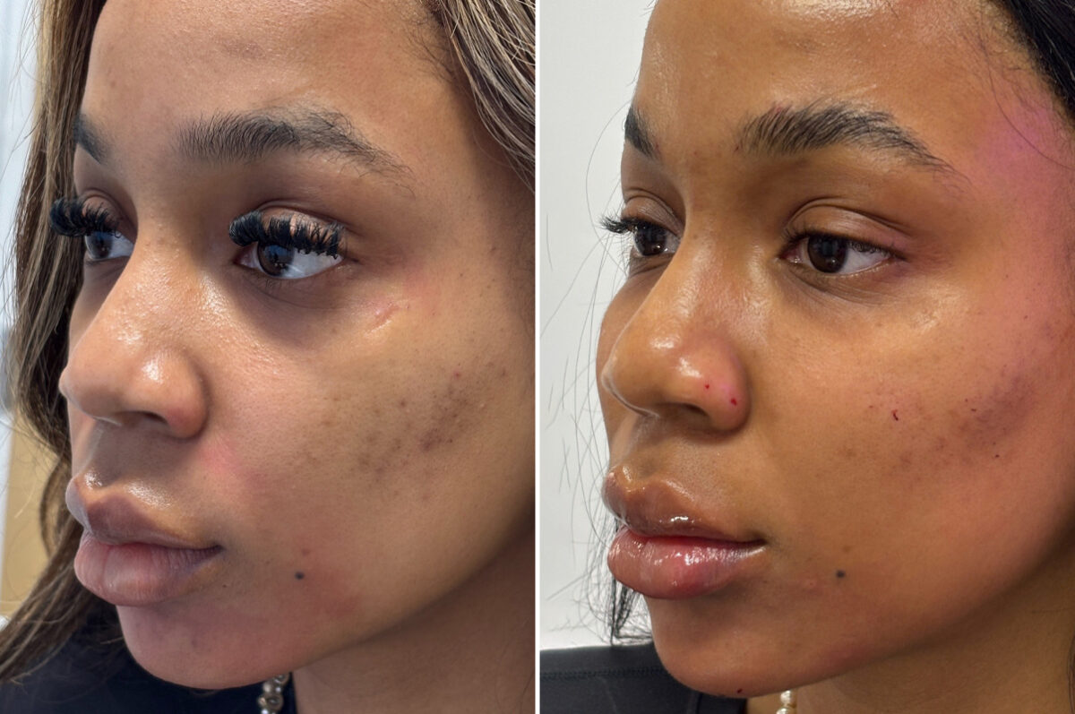 Injectable Fillers Before and After Photos in Philadelphia, PA, Patient 12679