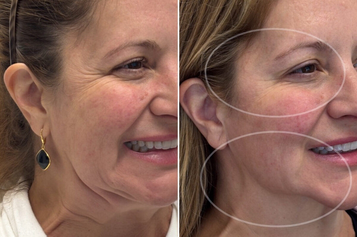 Botox Before and After Photos in Philadelphia, PA, Patient 12691