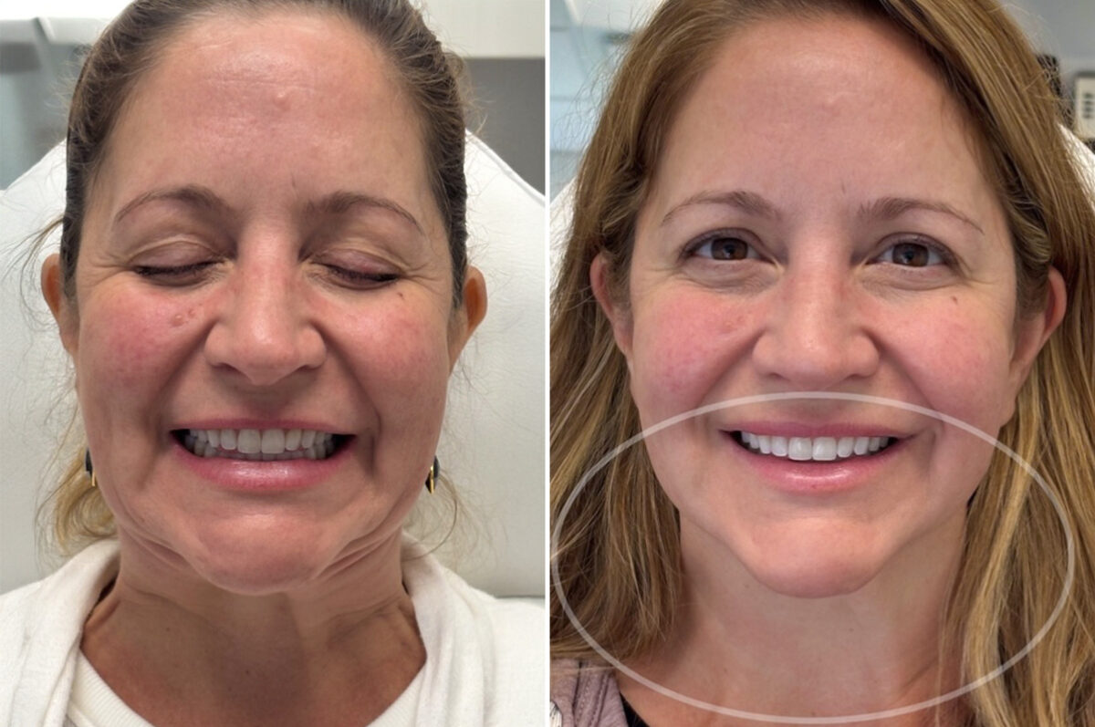 Botox Before and After Photos in Philadelphia, PA, Patient 12691