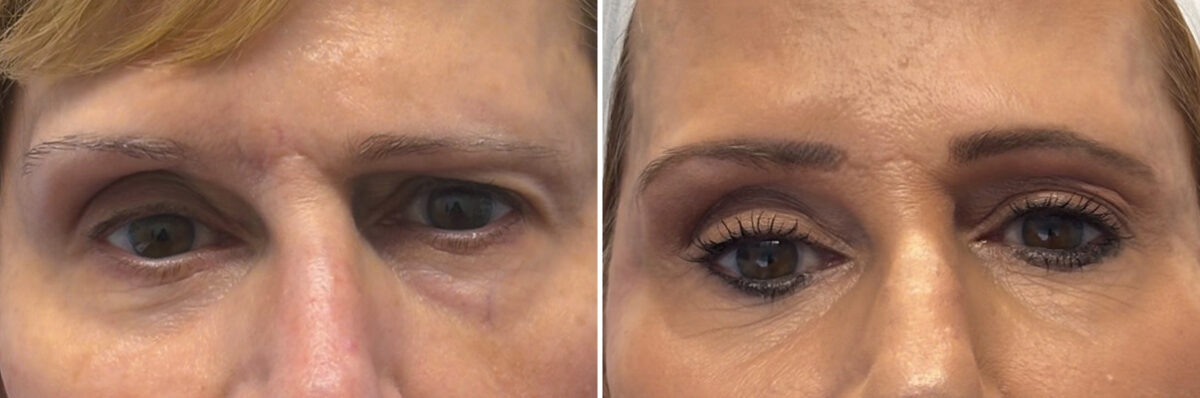 Botox Before and After Photos in Philadelphia, PA, Patient 12694