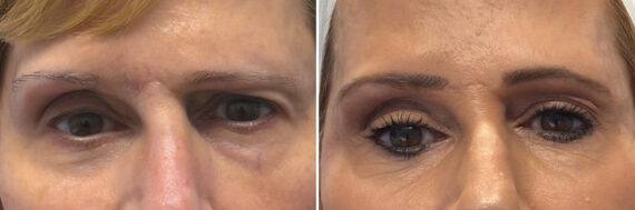 Botox Before and After Photos in Philadelphia, PA, Patient 12694