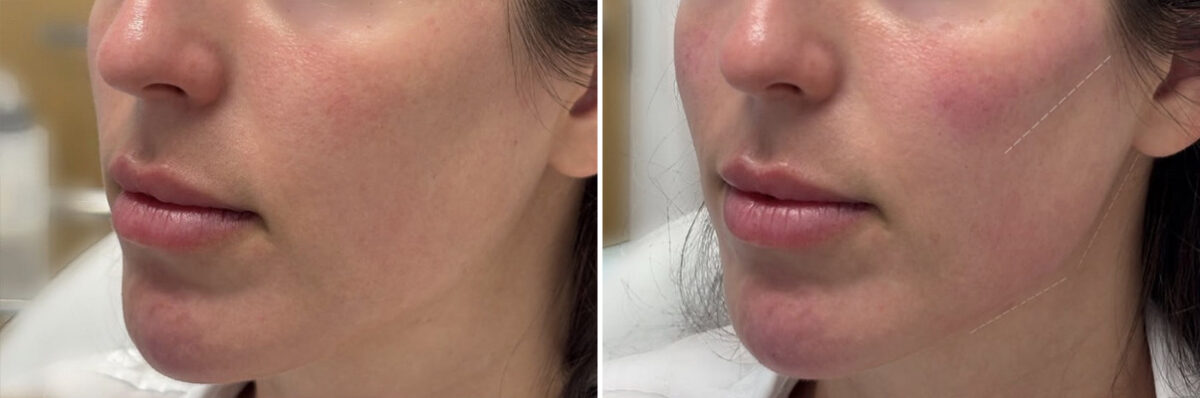 Injectable Fillers Before and After Photos in Philadelphia, PA, Patient 12698