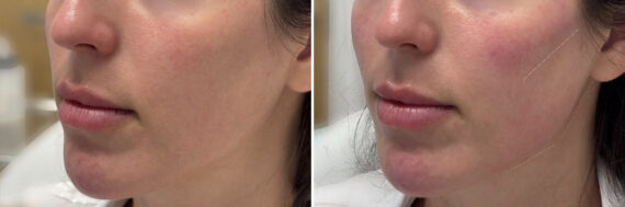 Injectable Fillers Before and After Photos in Philadelphia, PA, Patient 12698