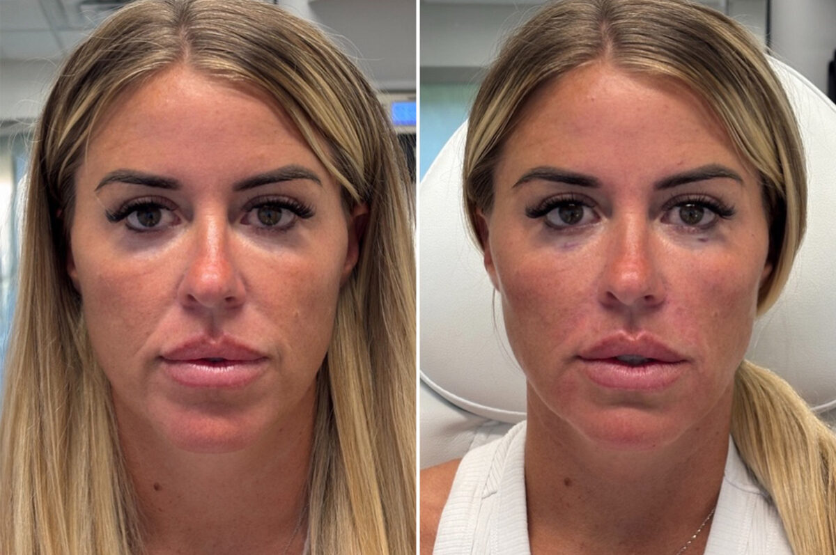 Injectable Fillers Before and After Photos in Philadelphia, PA, Patient 12702