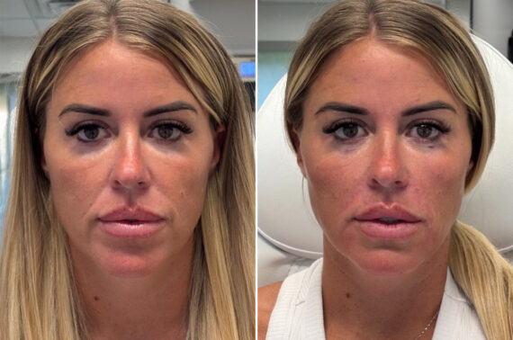 Injectable Fillers Before and After Photos in Philadelphia, PA, Patient 12702