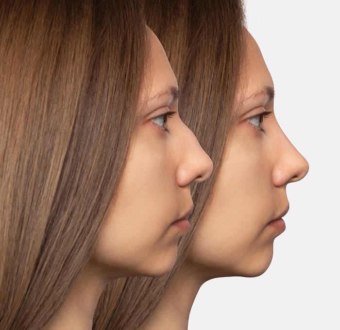 Side profile comparison showing the before and after effects of rhinoplasty for dorsal hump correction, with a smoother, more balanced nose shape.