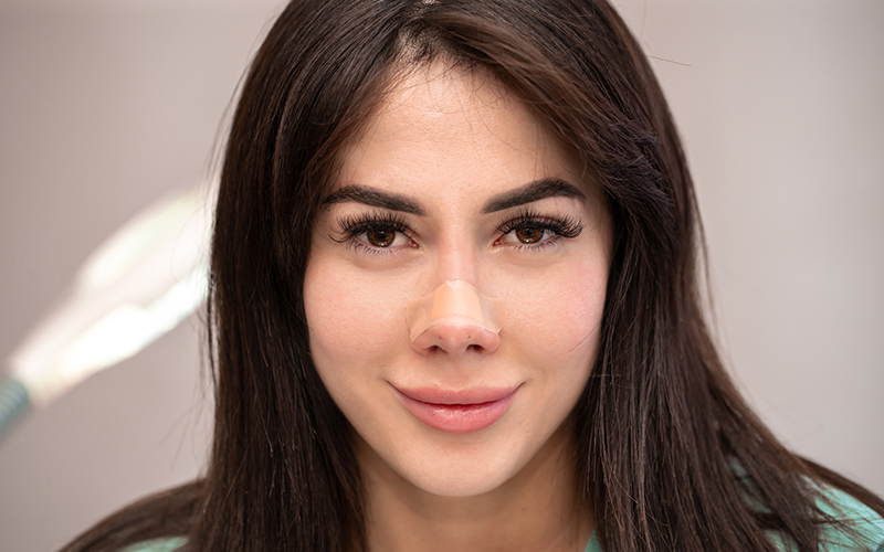 Patient with a nasal splint following rhinoplasty surgery to correct a dorsal hump, highlighting the difference between surgical and non-surgical rhinoplasty options