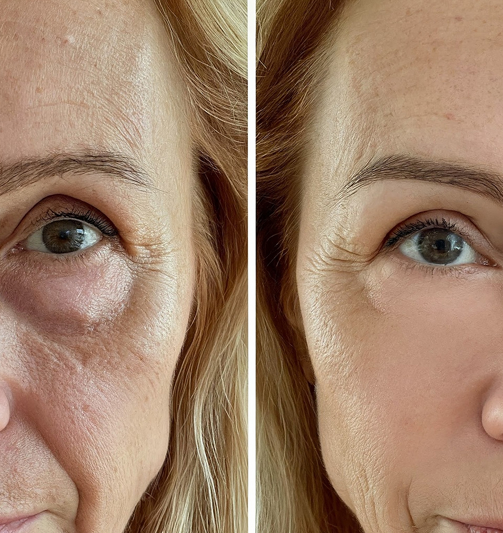 Side-by-side close-up of a woman's eye area showing before and after Botox treatment results on facial wrinkles