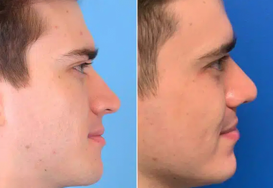 Before & After Nose patient lateral