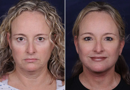 Before & After Facelift patient frontal