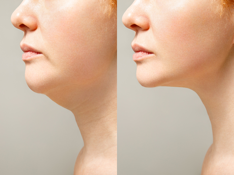 Side-by-side before and after view showing improved jawline and slimmer neck following cheek and face liposuction.