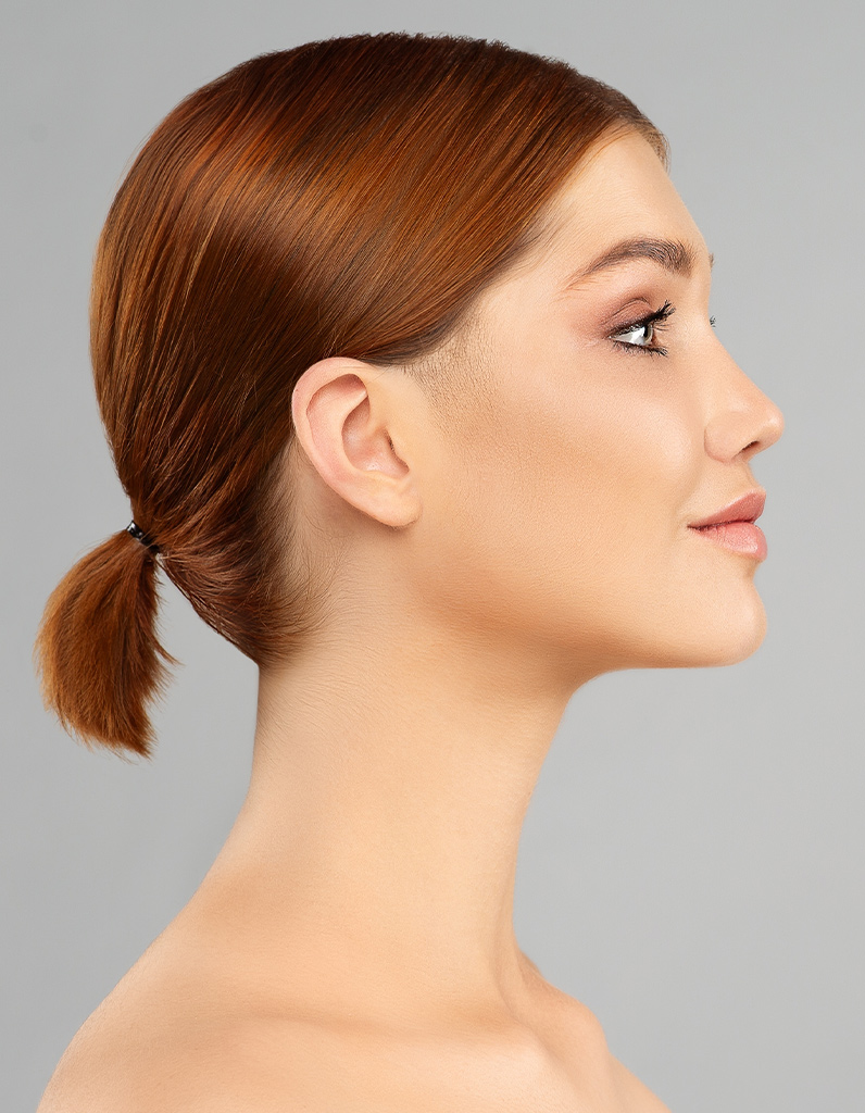 Side profile illustrating dorsal hump along the nasal bridge.