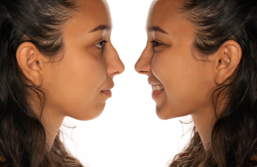 Side profile comparison of woman before and after ethnic rhinoplasty in Philadelphia highlighting refined nasal shape and balance