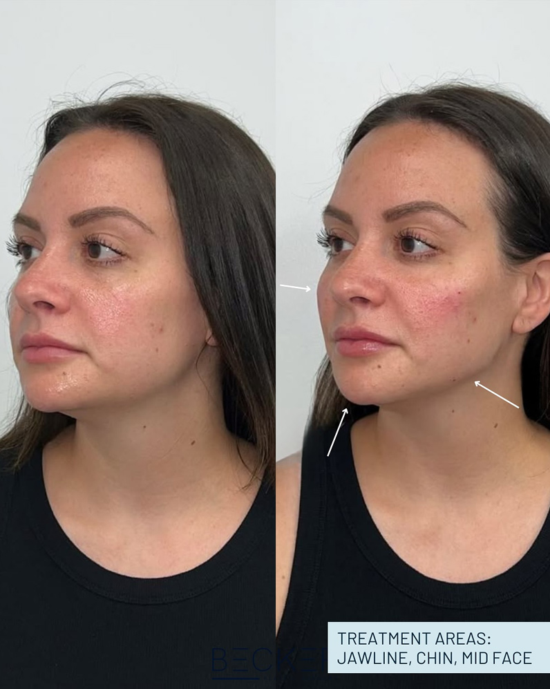 Before and after facial balancing showing improved jawline, chin, and midface symmetry with natural results.