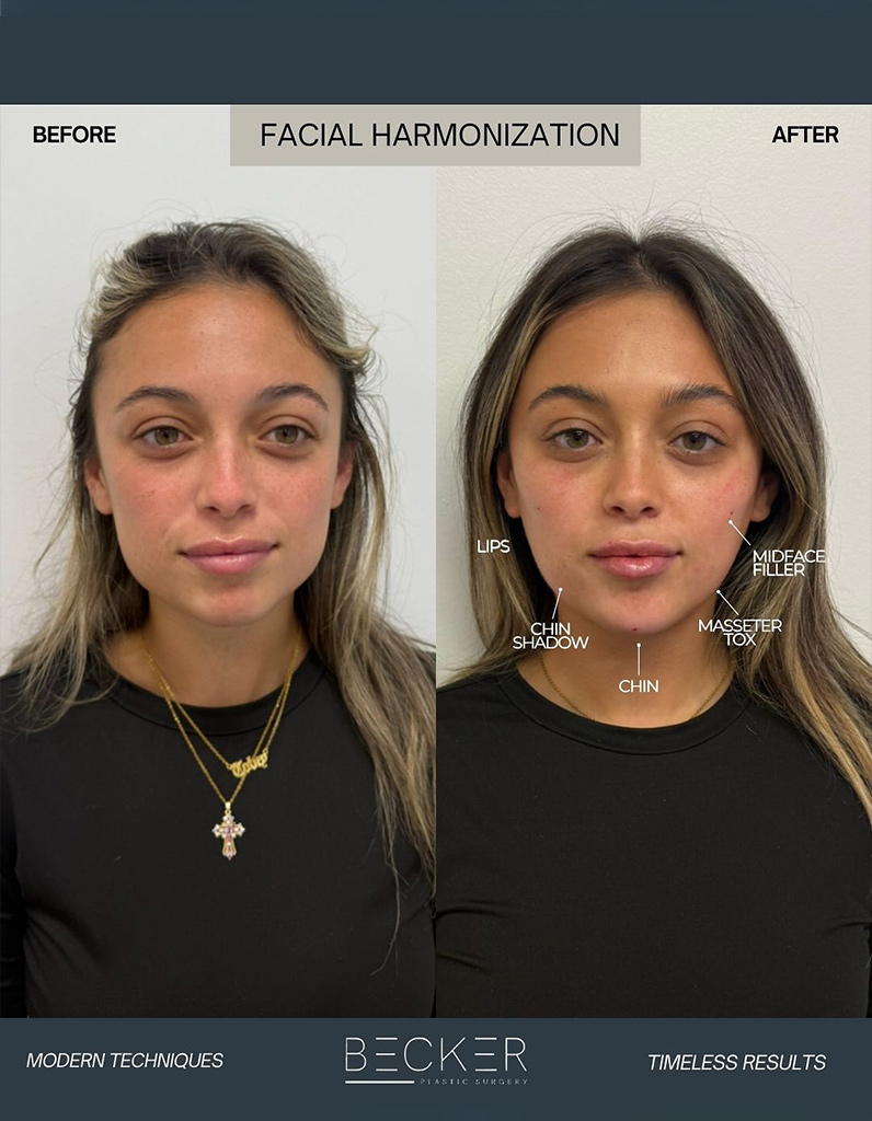 Front-view before and after showing enhanced facial balance with fillers and neuromodulators.