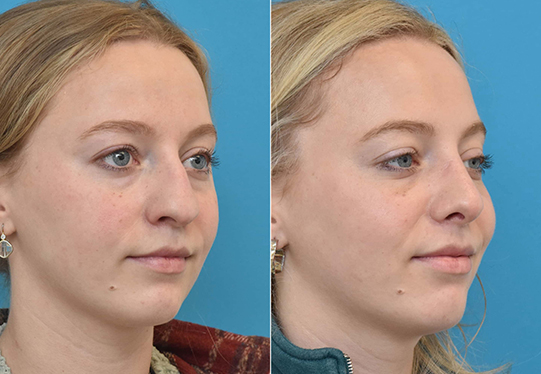 Before & After Rhinoplasty patient oblique