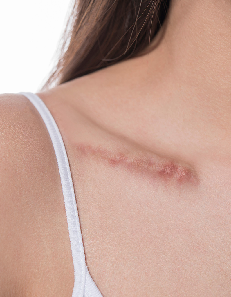 Raised chest scar representing a candidate for scar revision treatment