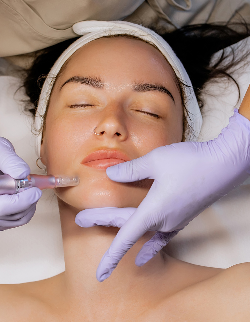 SkinPen microneedling treatment performed on lower face.