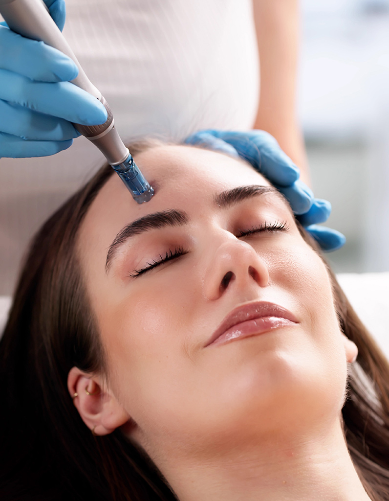 SkinPen microneedling device used on forehead during treatment.