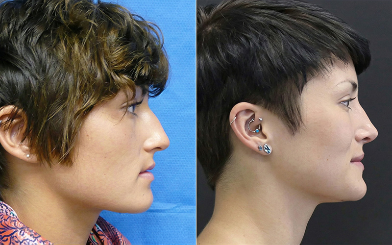 Before and after profile showing results of closed rhinoplasty