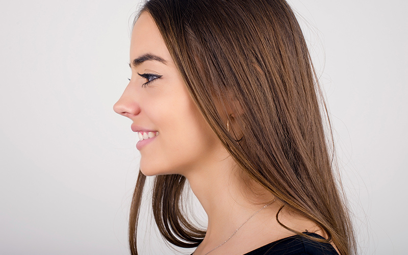 Side profile of woman with droopy nasal tip before rhinoplasty, highlighting nasal tip position and facial profile balance.