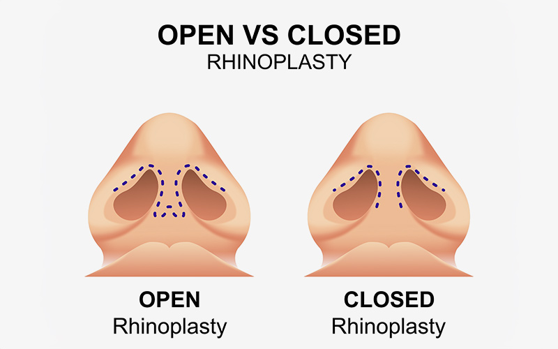 Diagram comparing open and closed rhinoplasty incision patterns