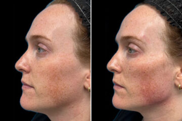 Facial Balance Before and After Photos in Philadelphia, PA, Patient 19453