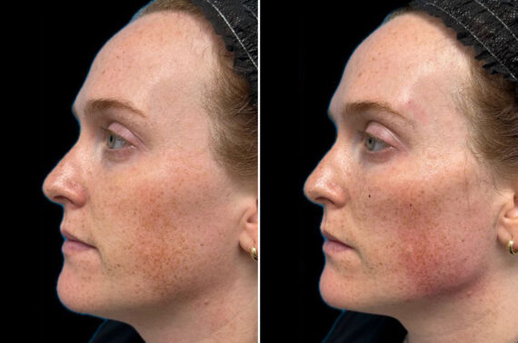 Facial Balance Before and After Photos in Philadelphia, PA, Patient 19453