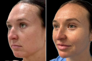 Facial Balance Before and After Photos in Philadelphia, PA, Patient 19458