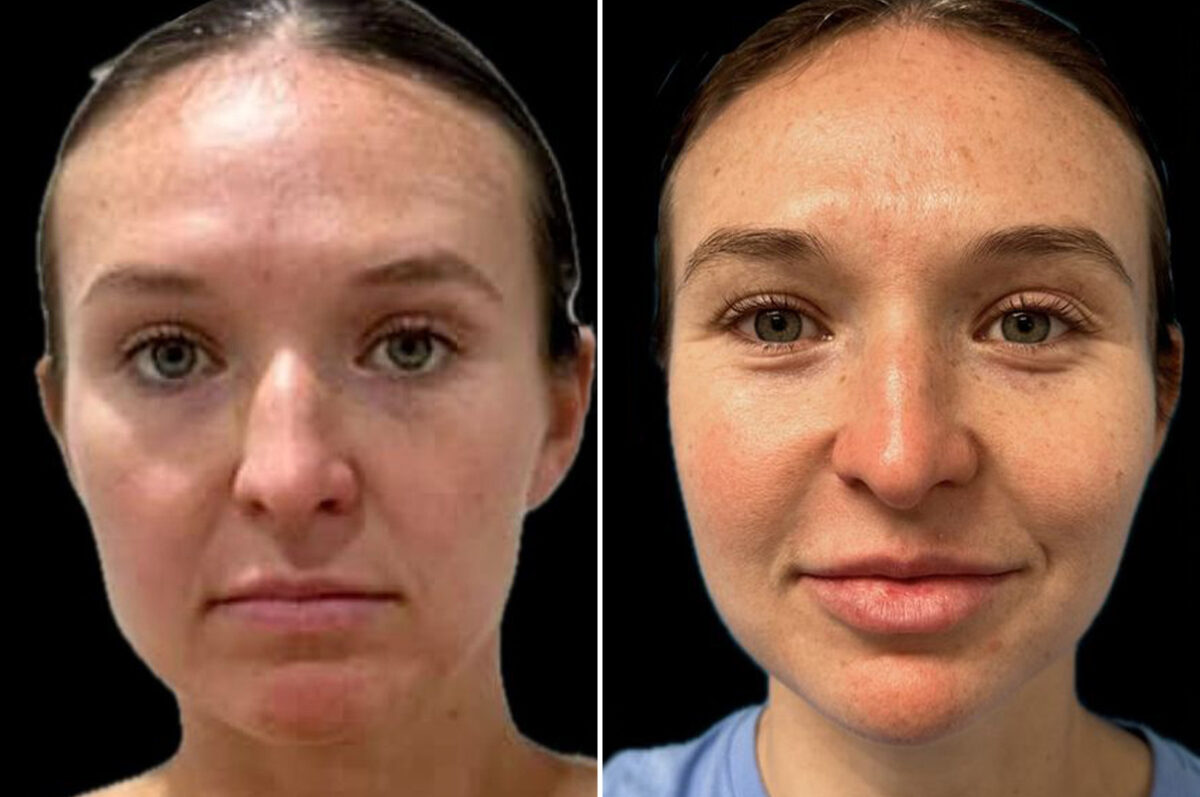 Facial Balance Before and After Photos in Philadelphia, PA, Patient 19458