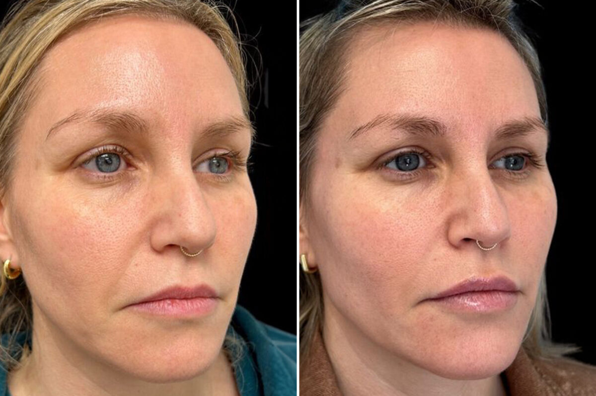 Facial Balance Before and After Photos in Philadelphia, PA, Patient 19467